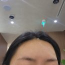 온다리프팅 6만줄 / 이마&amp;목주름 필러 솔직후기 !! 한번에 고민 해결