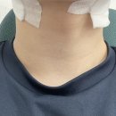 10년 동안 여드름인 줄 알았던 표피낭종 제거 수술 후기
