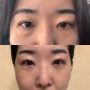 그대애 | 30대 직장인 눈밑지 성형후기 붓기 일주일 변화 부작용