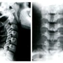 목디스크 검사법 distraction test, foraminal compression test, extension-compression, flexion-compression test 이미지