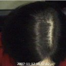 한성주한의원 | [잠실탈모/용인탈모] 치료인식이 부족한 20대! 탈모현상 급증 + 까망 후기