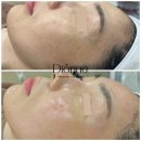 피부를 말하다 | 원주피부관리 디온 원주본점 슈퍼젝션 임상 성공을 말하다