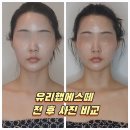 예비신부라면, 윤곽관리 더 늦기 전에 시작하세요! :: 유리햅에스떼