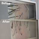 밝음메디 | 더노블메디센터 두피관리 탈모관리 후기 (+모낭충검사)