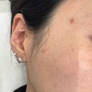 미더베스트 | 홍대모낭염여드름관리잘하는곳 미더베스트 홍대점 칵테일필 후기