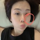 평촌수피부과의원 | [안양/피부과] 흑자레이저 리팟 후기, 9개월 시간 변화와 비용 @연의원