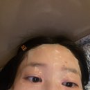 렌즈삽입 한달차