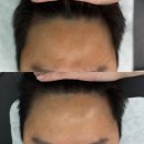 남자친구 헤어라인 받고 만족한 광교두피커버 모피던스 후기