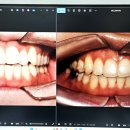 진심을 담은 치과교정과 치과의원 | [ 내돈내산 성인치아교정 인비절라인 두번째 일기 ] 벌써 중간점검 받은날 !!!