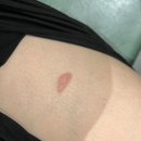 하남미사 파더스화외과의원에서 내돈내산 고데기화상 흉터 레이저 후기