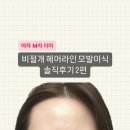 내돈내산 | 비절개 헤어라인 모발이식 솔직후기 2편 (가격/ 수술방법/ 수술후기/ 경과사진)