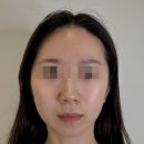 비알부티크 | 예비신부를 위한 청담동 피부관리 비알부티크 V9 시그니처 리프트 리얼 후기 윤곽부터 광채까지!!