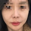 비포앤애프터 프라이빗짐 | 티타늄리프팅 내돈내산 80KJ 받고 효과 2배 본 듀얼티타늄 후기