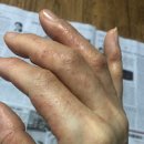 한포진 원인 증상 치료 손가락 한포진 발가락 한포진 한포진 완치 전염 이미지