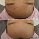 좁쌀여드름이요? 아쿠아필+물광필로 청소하고 수분보충! 쌍문역피부관리 늘품에스테틱