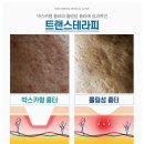 노원여드름피부과 흉터 채움과 유지력을 높이는 법