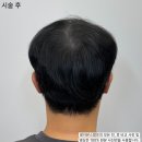 레이븐스칼프