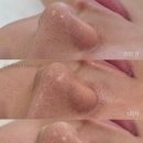 갓차워시 프로페셔널 용인처인점 | 팔드름 왜 생기고, 어떻게 관리해야 할까요?