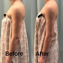 (주)티에스 메디라인 | 광주웨딩관리 팔뚝 승모근 드레스라인 전문 365메디스킨 2회차 후기