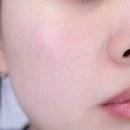 (주)이오기술 | 나비존모공 케어 이오에이 장나라 풀텐자 1달 후기