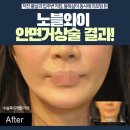 얼굴실리프팅 대신 안면거상수술 통해 안면리프팅 효과 시도해봤더니 안면거상술효과 이미지