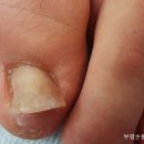 손톱쟁이,발톱쟁이