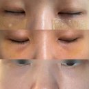 호호호약국 | 서울 강남 눈밑지방재배치 붓기 멍 통증 단점 1일차 ~ 12일차 내돈내산 후기