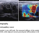 Thyroid papillary cancer -Elastography 이미지