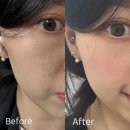 부산큰병원(급식실 포함) | 화명동피부과 부산쥬베룩볼륨 상세 후기