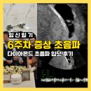 다이아몬드 | 임신 6주차 증상 초음파 다이아몬드 후기