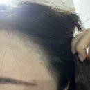 모우림의원 | [헤어라인모발이식후기] 압구정모우림의원 헤어라인 모발이식 재수술 후기