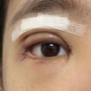 하니네 | 하니성형외과 쌍꺼풀재수술, 윗트임, 써클트임(밑트임+뒷트임) 한달차 후기