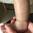 청운대학교 건너편 이디야커피 앞 | [마포공덕 에스앤유피부과] 손등, 발목 이소성 몽고반점 3회차 치료 경과 사진 &amp; 비용 &amp; 주차 Tip
