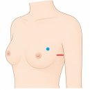 이원의료기부산대학병원점 | 유방절제술 후기 (2편) (43세, 섬유상피성병변 2.5cm, 부산대학병원)