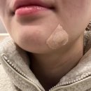 바로그의원 | [바로그의원 마산점] 점 제거 내돈내산 후기 / 시술 후 2주 경과 사진