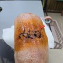 2025.12.9화요일 의왕한국한센복지협회병원 오른다리수술경과사진수술6일째 이미지