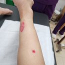 새살님오토바이 | 심재성 2도 화상_오토바이 머플러 화상 후기_1탄