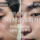 안양 기미제거 레이저토닝 5회차 받은 후기/잡티 색소 사라지는 과정