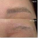 서울눈썹문신제거 잘하는 곳 찾는다면? 이츠제이 본점 리얼후기