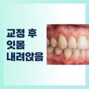 태백홈케어 | 교정 후 잇몸 내려앉음 내려감 아픔 부음 왜 나만 유독 심할까?