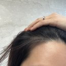 복한의원 | 압구정 탈모치료전문 헤어진 모낭주사 맞고 온 후기