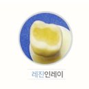 e조은치과기공소 | 인창동치과, 인레이 치료를 앞두고 계신가요?