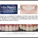 한양수치과 | 유치가 안빠져요..! 유치잔존(잔존유치) 라미네이트 후기 [예뻐지는 라미네이트 수치과병원]