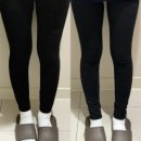 신사-108 | 신사다이어트병원 [제로컷] 지방분해주사 솔직후기 4회차