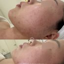 비앙리에 | 울산피부관리 에스테틱 비앙리에 골드여드름 흉터재생 관리 받은 후기