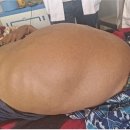[앗, 이런 일] 소아기부터 배 부풀었던 청년... 그 뱃속 열어본 결과? 이미지