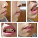[준이 교정일기] 강남교정전문치과(아인스치과)에서 부정교합 교정기로 교정한 준이 치아교정 전후 후기