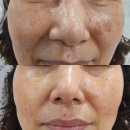 대구 흑자 없애는곳, 달서구 성당동 지아뷰티 사진후기