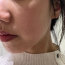 얀의원 올리지오 리프팅후기 (가격/삼성중앙역피부과/3회차효과)