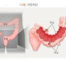 대장 게실증 원인 증상 치료 게실염 원인 증상 합병증 대장게실증과 게실염 차이 이미지